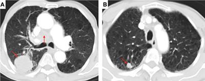 Successful Treatment of an Elderly Patient With Combined Small Cell Lung Cancer Receiving Anlotinib: A Case Report